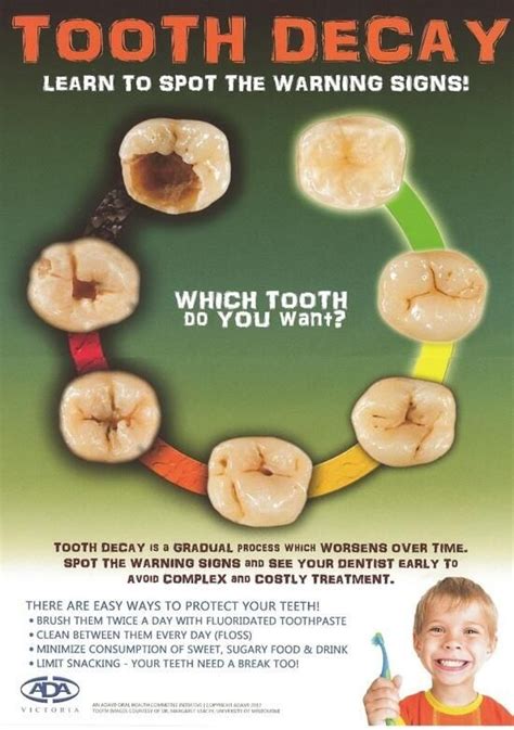 Nijjar Dental Blog What Does A Cavity Look Like