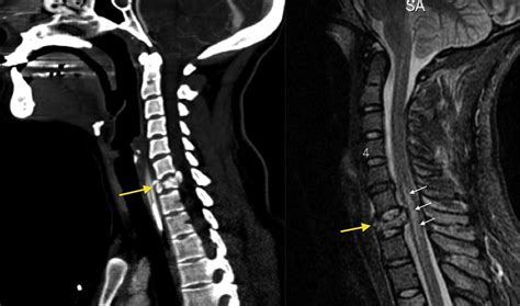 Cervical Burst Fracture Radiology At St Vincents University Hospital