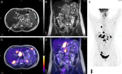 Staging Petmri Scan Of A 56 Year Old Woman With Known Ovarian Cancer