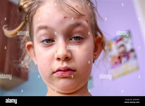 Smallpox Small Pox Disease Hi Res Stock Photography And Images Alamy