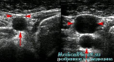 Диета для тромбоза глубоких вен УЗИ тромбоза глубоких вен. Техника, достоверность УЗИ тромбоза глубоких вен. Техника, достоверность Диета для тромбоза глубоких вен
