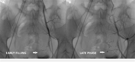 Selective Left Internal Iliac Angiogram A Early And B Late Phase