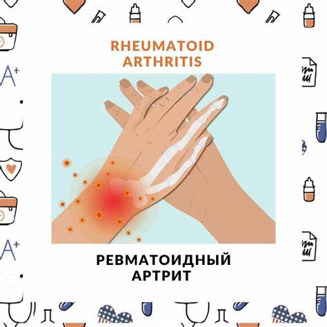 Ревматоидный артрит Картинка - Ревматоидный артрит