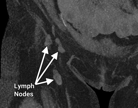 Vascularized Lymph Node Transfer A Primer For The Radiologist