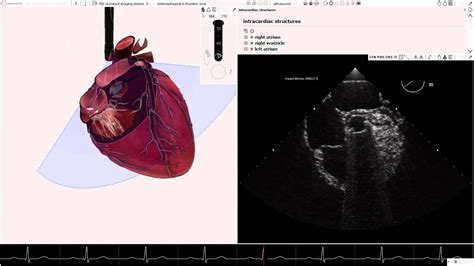 Heartworks Mechanical Aortic Valve Youtube