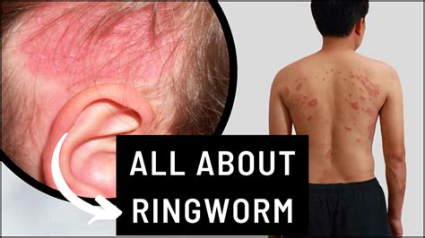 All About Ringworm Symptoms Treatment And Diagnosis