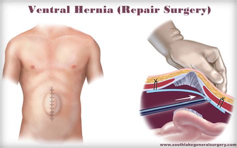 No Mesh Hernia Surgery Ventral Hernias No Mesh Ventral Hernia Repair