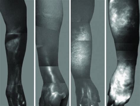 Md Anderson Lymphedema Classification Based On Injected Indocyanine Download Scientific Diagram