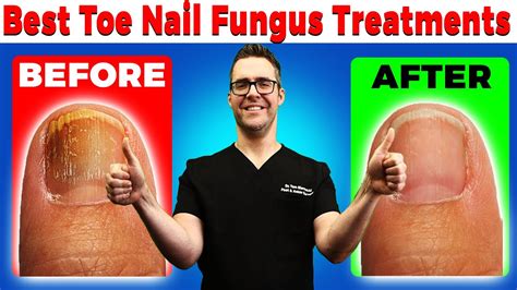 Best Toe Nail Fungus Treatments 2022 Onychomycosis Remedies