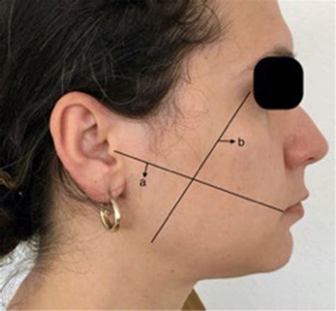 Measurement Of Facial Dimensions A Tragus Lateral Commissure Line B