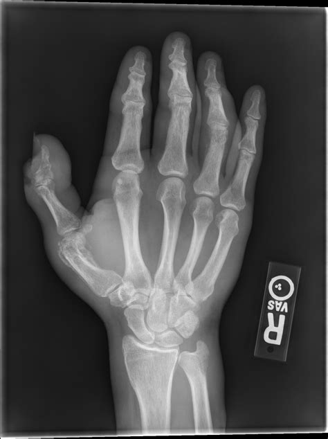 Thumb Fracture Buyxraysonline