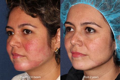 Rosacea Facial Redness Treatment By San Diego Specialists