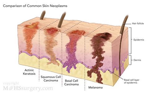 Skin Cancer And Melanoma Causes Symptoms Treatment Health Life Media