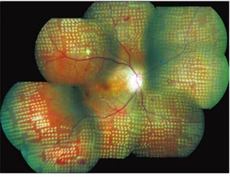 Retinal Laser Types Procedure Neoretina