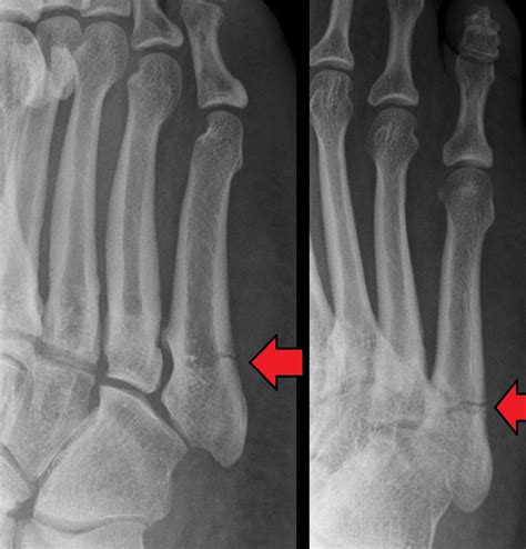 Fifth Metatarsal or Jones Fracture