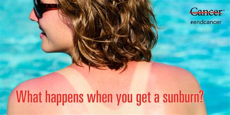 What Happens To Your Skin When You Get A Sunburn Md Anderson Cancer