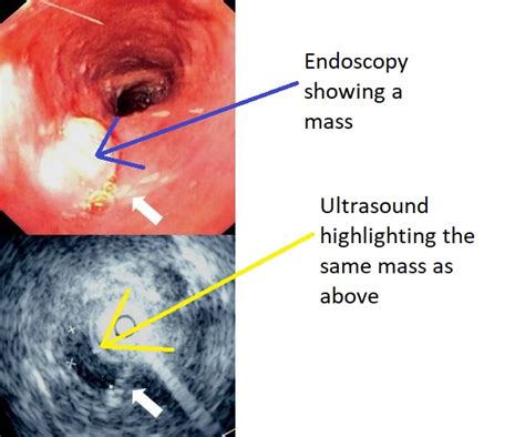 Esophageal Cancer Echocardiography And Ultrasound Wikidoc