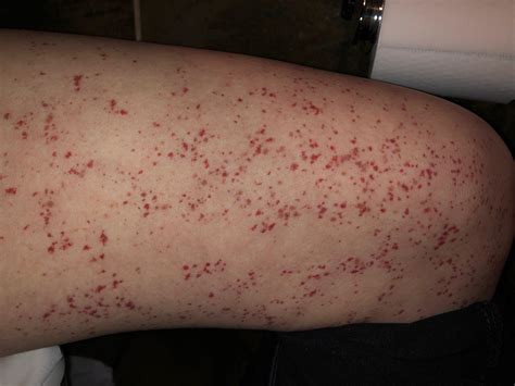 red spots on skin pictures causes treatment online de