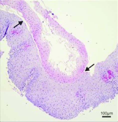 Biopsy Of Esophageal Squamous Mucosa Showing A Cleavage Plane Arrows