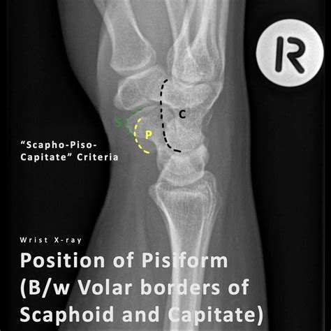 Normal Anatomy Of Lateral Wrist Radiograph Pulse Md