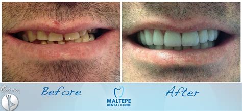 Dental Veneers Before And After Pictures Turkey Dentistry Istanbul