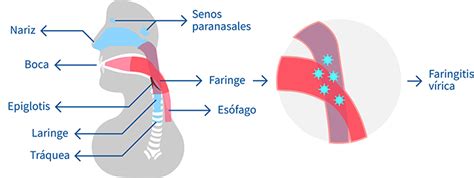 Faringitis Viral Causas Síntomas Y Tratamiento
