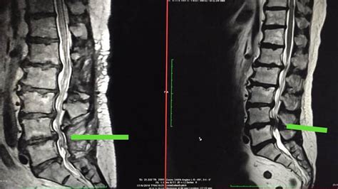 lumbar spinal stenosis mri the hong kong chiropractor and neurosurgeon medical center