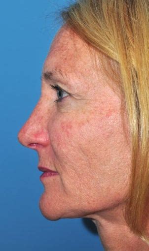 Female Treated For Sun Damaged Skin Photo From Ryan Greene Md Phd