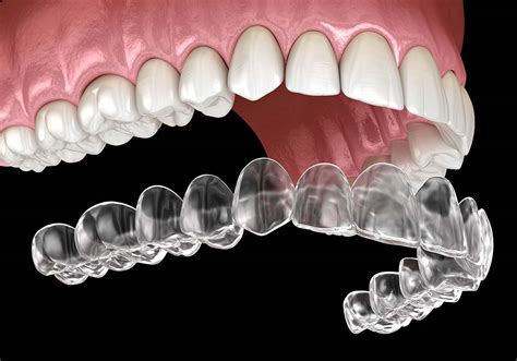 Clear Aligners Jetty Road Dental Clinic