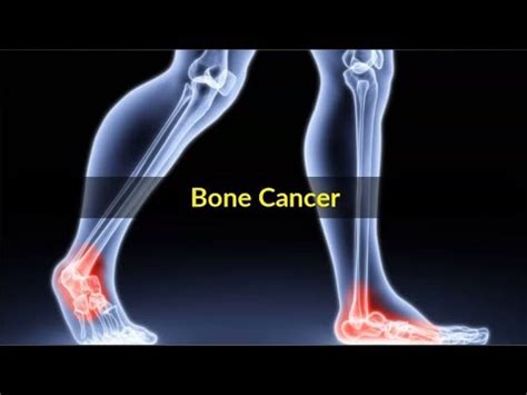 Learn how bone cancer is diagnosed and treated. Bone Cancer Symptoms - Pictures, Causes and Symptoms of ...