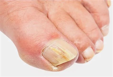 How Do You Get Rid Of Thick Toenails Causes And Treatment