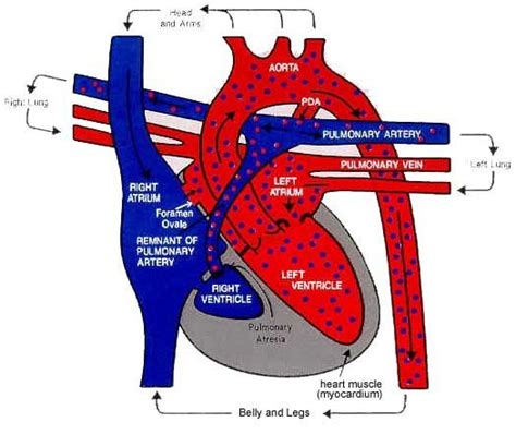 27 Best Single Ventricle Defect Images On Pinterest Congenital Heart