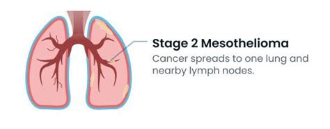 Mesothelioma Stages Understanding The Four Stages