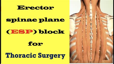 Erector Spinae Plane Esp Block For Thoracic Surgery Youtube