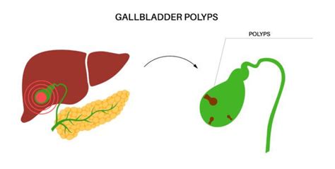 What To Do About Gallbladder Polyps Cabot Health