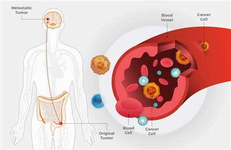 Metastatic Colorectal Cancer May Spread Early Nci