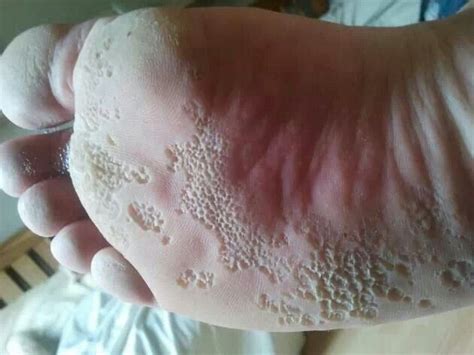 Pitted Keratolysis Is A Skin Condition Affecting The Soles Of The Feet