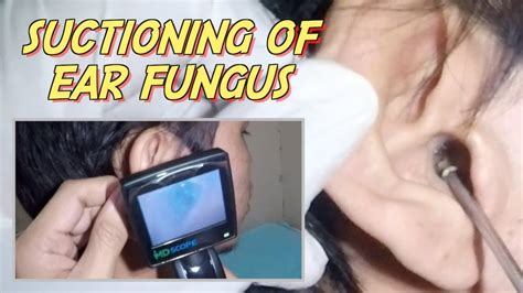 How To Treat Ear Fungal Infection Otomycosis Ear Suctioning Youtube