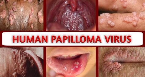 Human Papilloma Virus Hpv Facts And All You Need To Know About Hpv