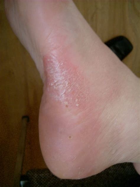 Blisters On Feet Can Be Due To Eczema Psoriasis Or Fungal Infections