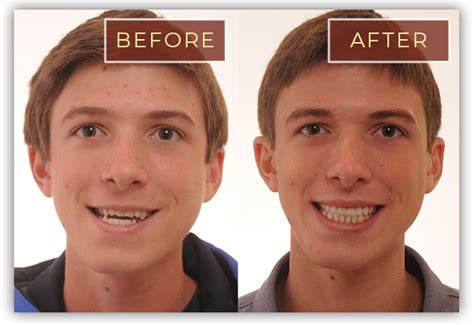 People Before And After Braces