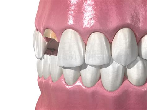 Broken Central Incisor Tooth Medically Accurate 3d Illustration Of