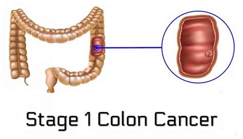 Colon Cancer Early Warning Signs And Stages Of Colon Cancer Page 12 Of 16 Healthella