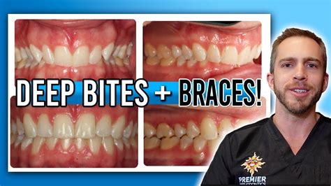 Deep Bite Braces Treatment Before And After Youtube