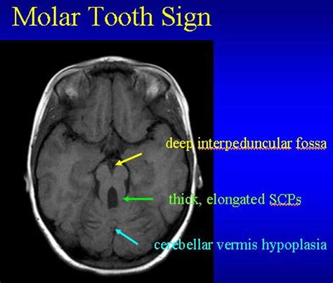 Joubert Syndrome Causes Symptoms Diagnosis Treatment And Prognosis