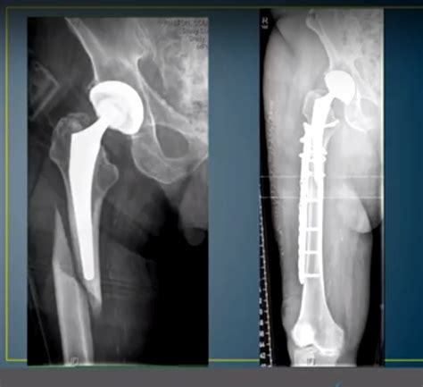 Periprosthetic Fractures After Total Hip Replacement