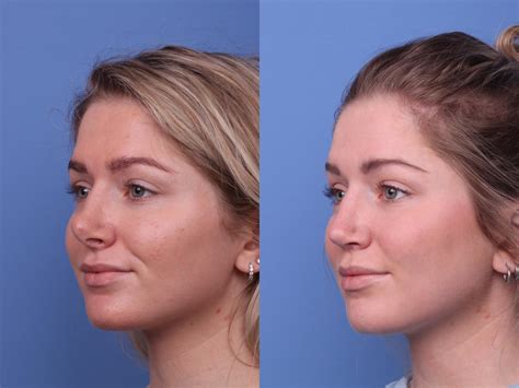 Rhinoplasty Before And After Things A Nose Job Can Achieve Hobgood