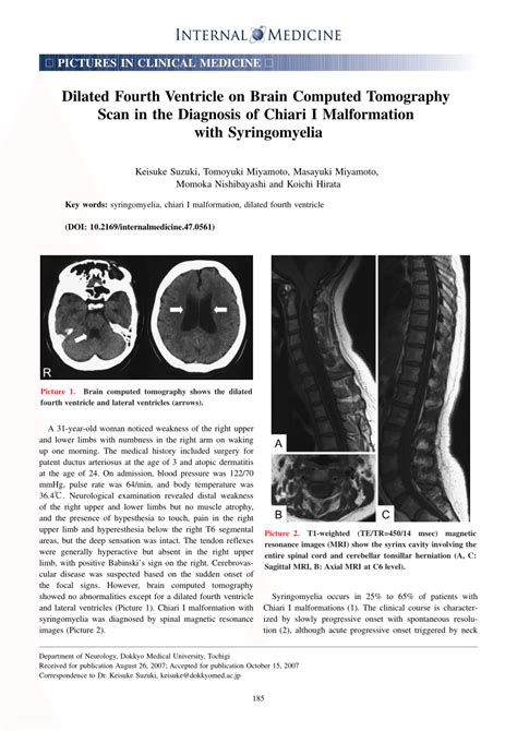 Pdf Dilated Fourth Ventricle On Brain Computed Tomography Scan In The