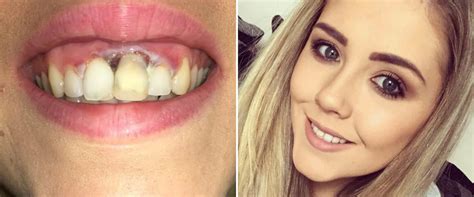 What Happens If You Burn Your Gums With Teeth Whitening