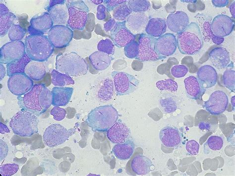 Acute Leukemia Leukemia Myeloid Acute Pathology